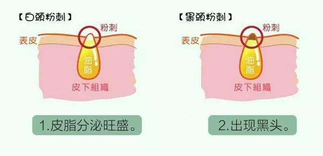 一篇祛痘总结:什么痘就该有什么治法! 一篇祛痘总结:什么痘就该有什么治法!