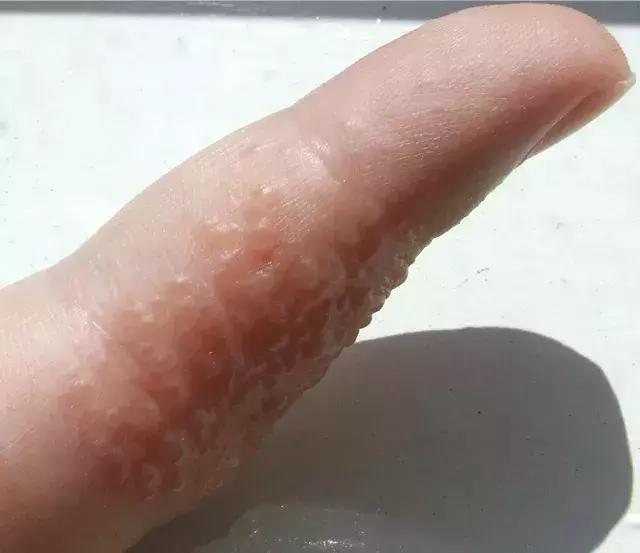手指上长出小水泡。是脚气病还是汗疹? 手指上长出小水泡。是脚气病还是汗疹?
