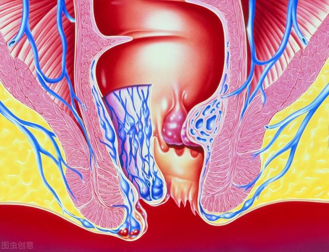 中医辨证治疗痔疮1例：55岁，痔核脱出，便后出血，肛门坠胀
