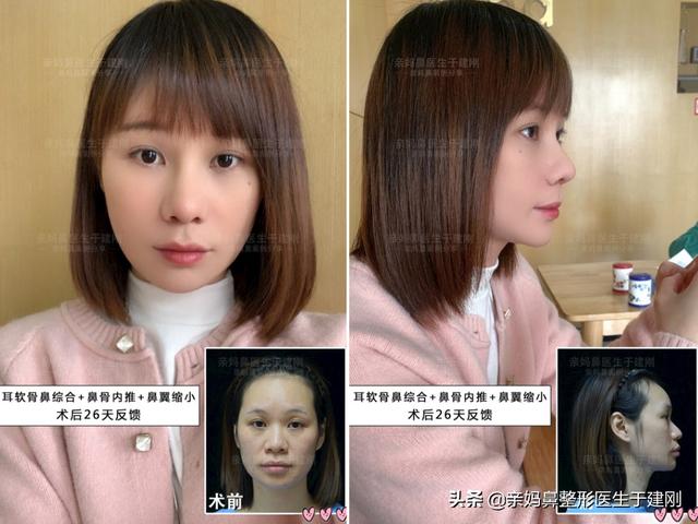 35岁深圳姑娘 鼻头大想做鼻整形 初次隆鼻却还意外