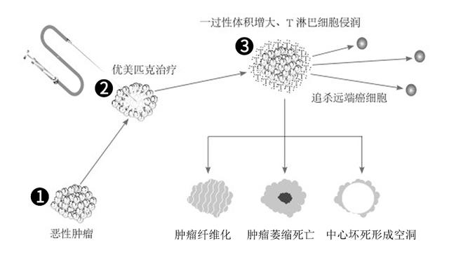 癌中之王 胰腺癌治疗新方案 瘤内缓释库治疗 生存