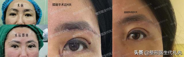 提眉手术多大年龄做最好 多久疤痕会完全消失 恢复期是
